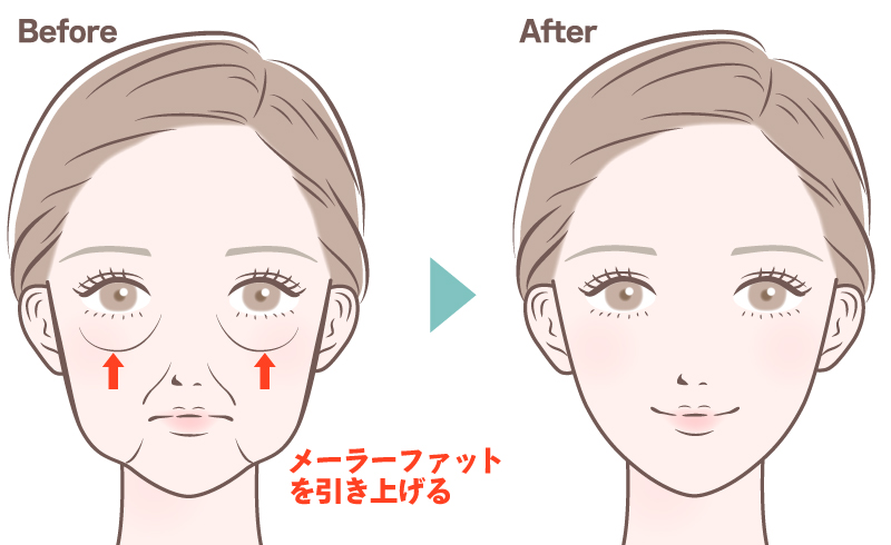 術前・術後イメージ