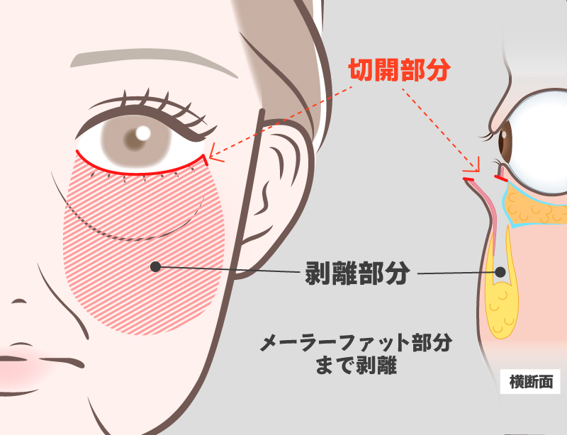 ミッドフェイスリフト術式イメージ1