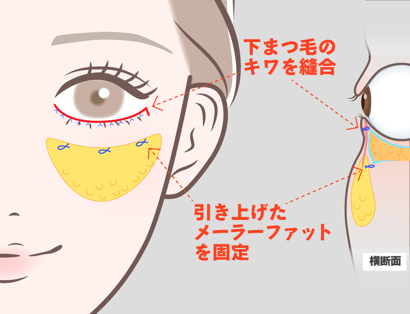 ミッドフェイスリフト術式イメージ3