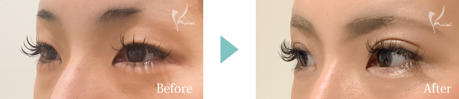 MT埋没法の写真