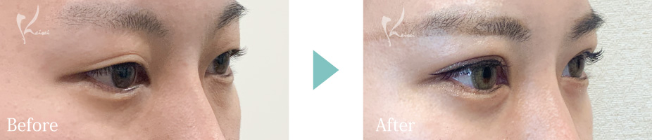 MT埋没法の写真