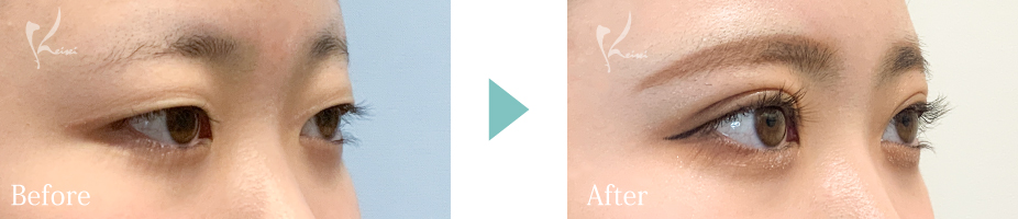 MT埋没法の写真