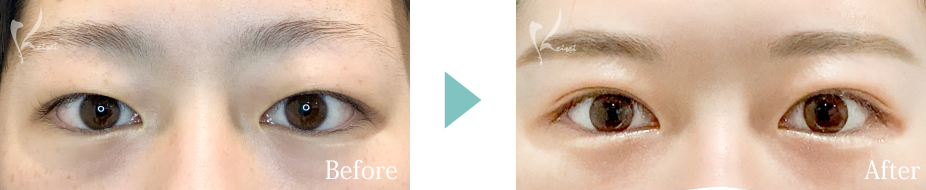 MT埋没法の写真