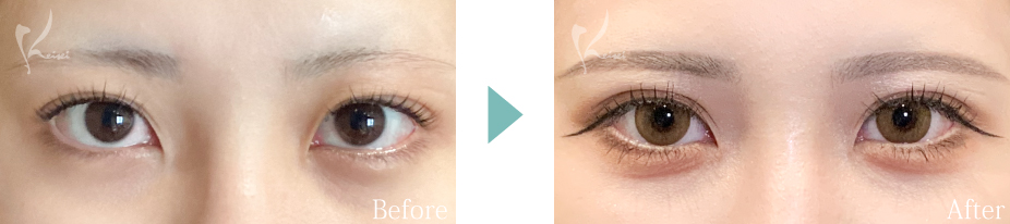 MT埋没法の写真