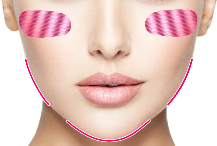 輪郭3点（頬・エラ・オトガイ骨切り）