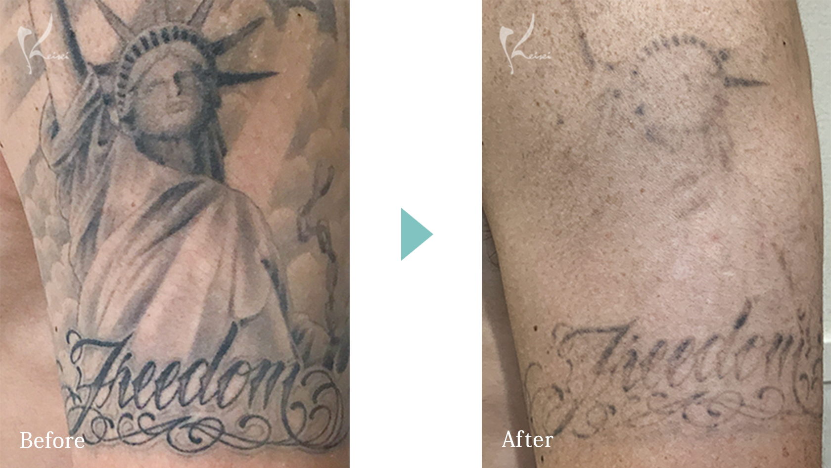 ピコタトゥーの症例画像　その１