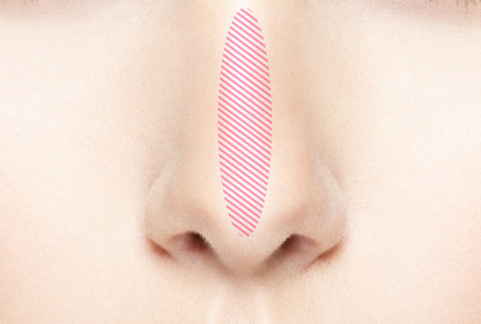 保存的鼻整形術（Preservation法） サムネイル