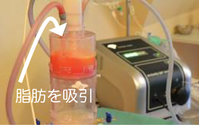 脂肪を吸引(写真)