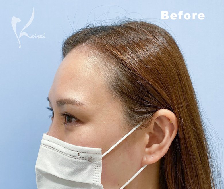 額にPRP注入前の額の斜めからの画像　その2