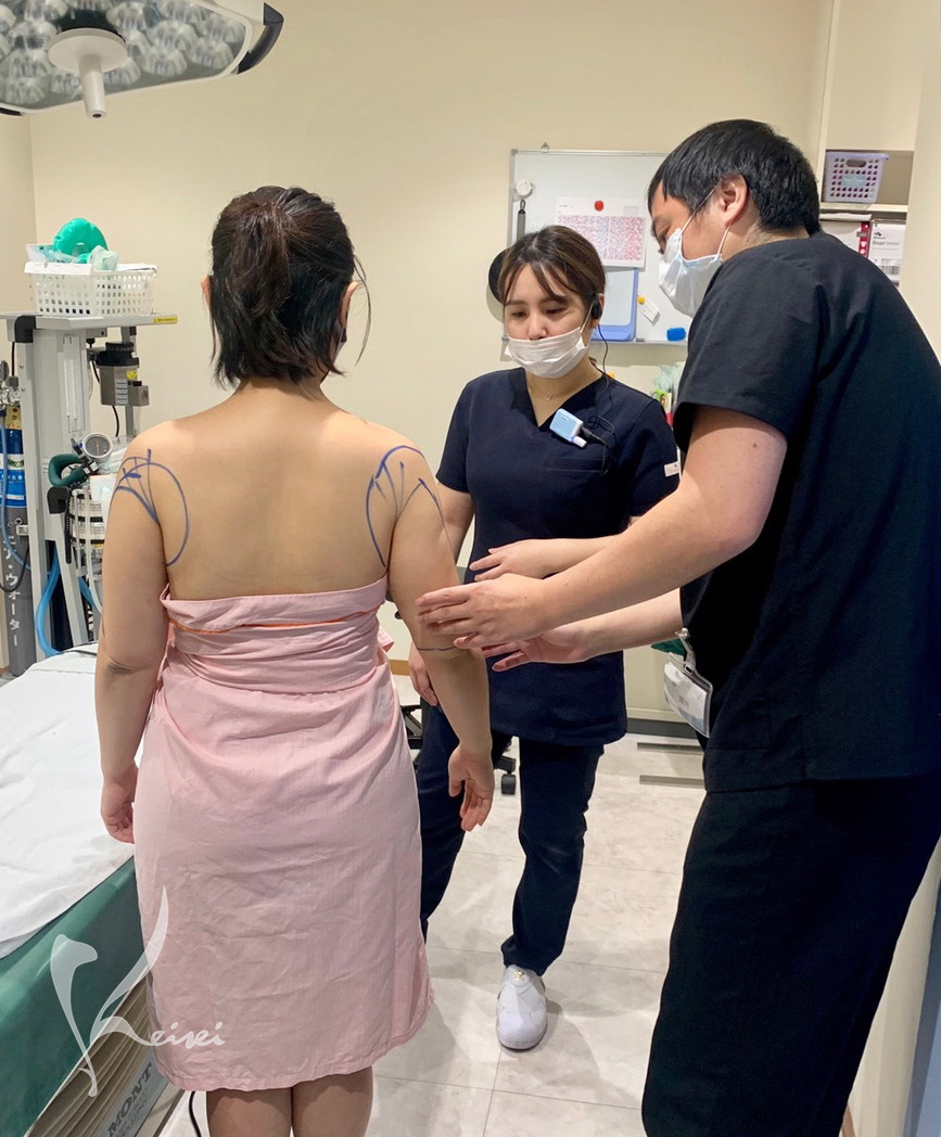 上腕全周の脂肪吸引のためのデザインの様子の画像