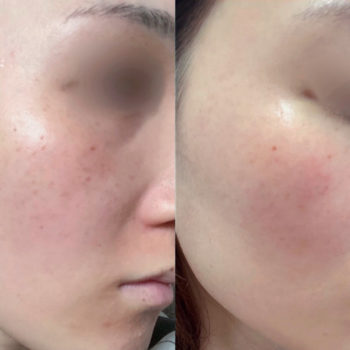 セラピューティック開始前と開始から九日後の頬の比較の画像