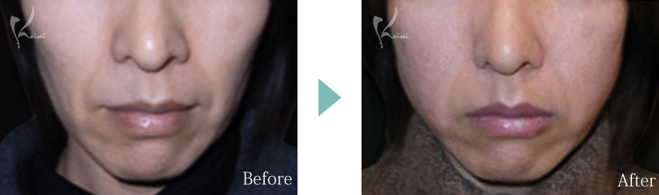 ホホ こめかみ へこみ くぼみ 脂肪注入 大阪 フェイスライン 症例