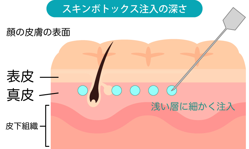 スキンボトックスの注入の深さ