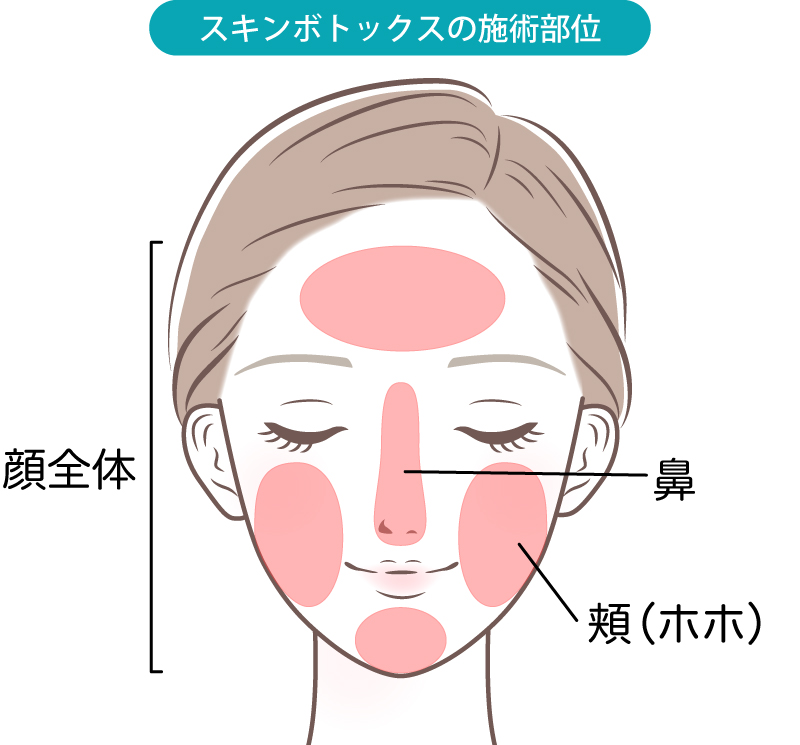 スキンボトックスの施術部位