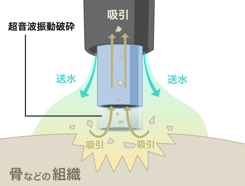ソノペット機能（破砕・吸引・送水）イラスト