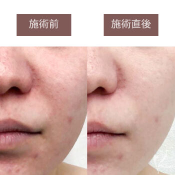 顔の赤みにお悩みのあなたへ！おすすめ施術【フォトフェイシャル】