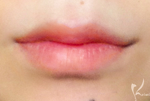 ヒアルロン酸を注入した唇