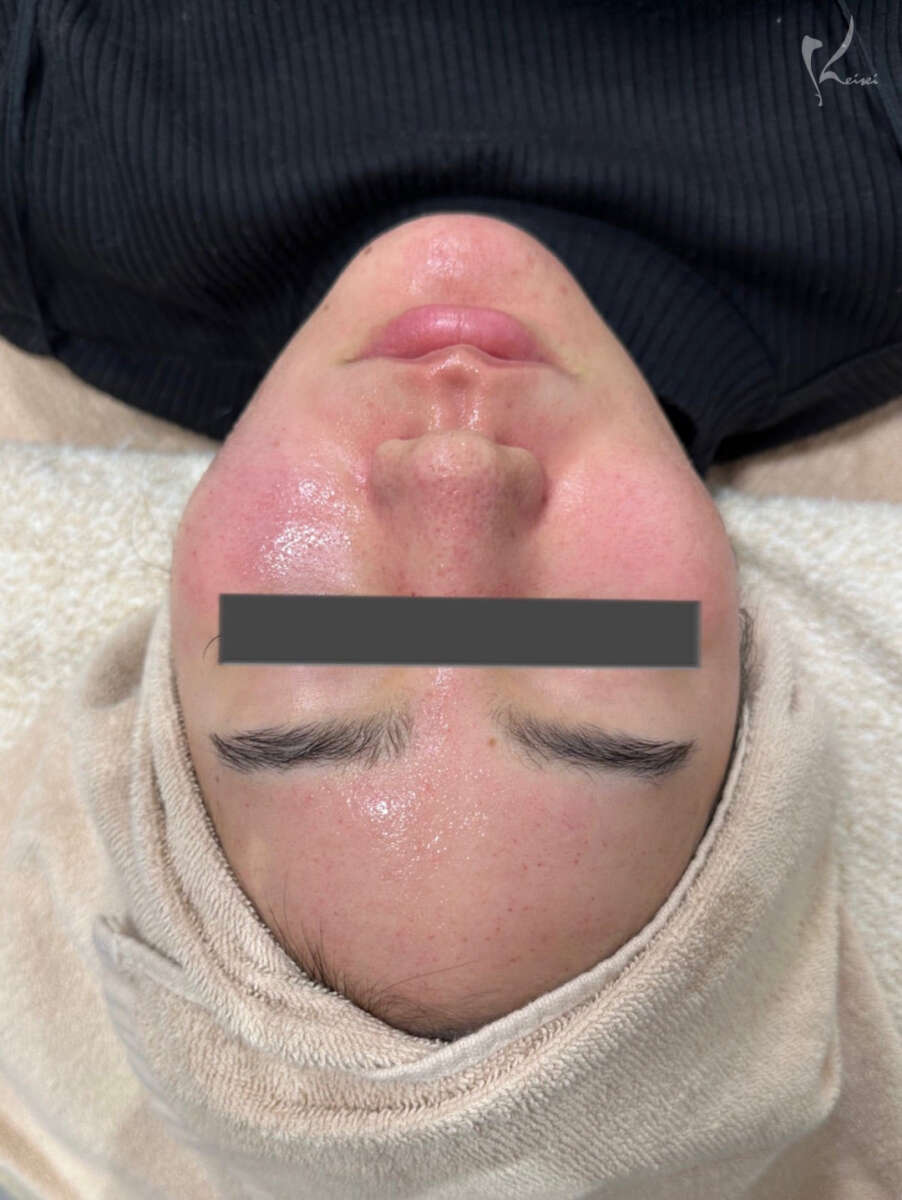 ポテンツァ　ドラッグデリバリー　ジュベルック　術直後