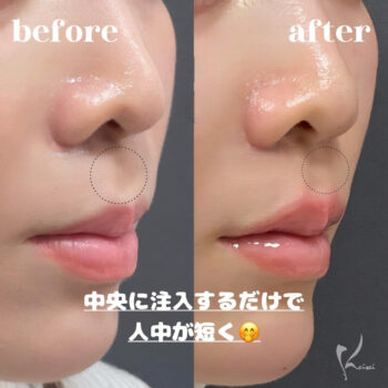 5分でできる！こっそり人中短縮