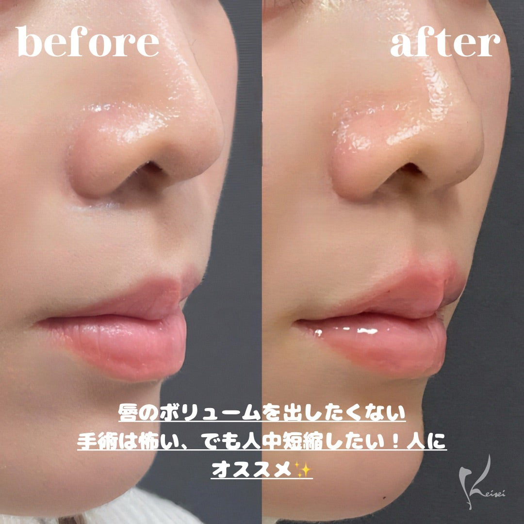 人中短縮の症例