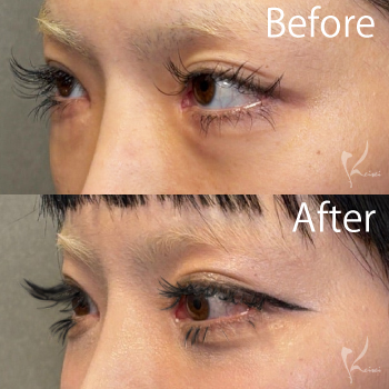 目の下脱脂で涙袋爆誕　サムネイル