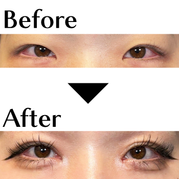 目頭切開＋埋没で平行二重に✨