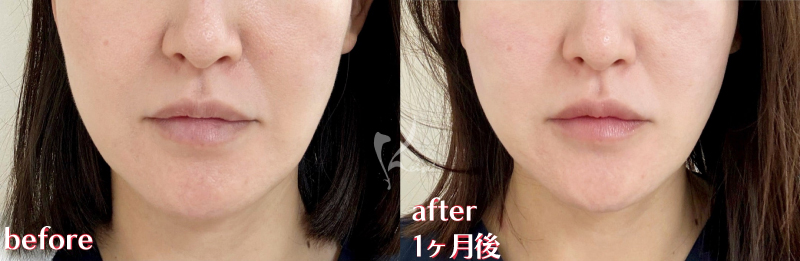 正面Before After写真