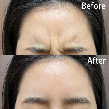 ボトックスで印象を変えよう！！