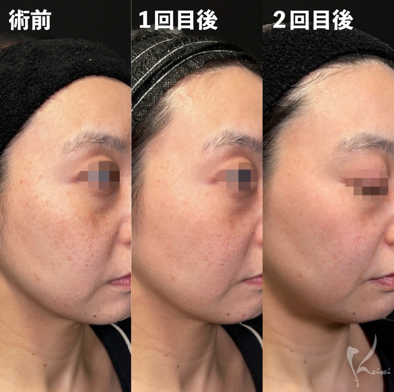 術前・1回目後・2回目後写真