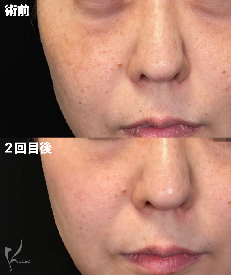 術前・2回目後写真