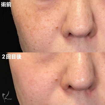 さよならシミ・そばかすサムネイル