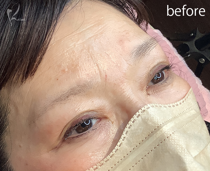Before写真アートメイク眉