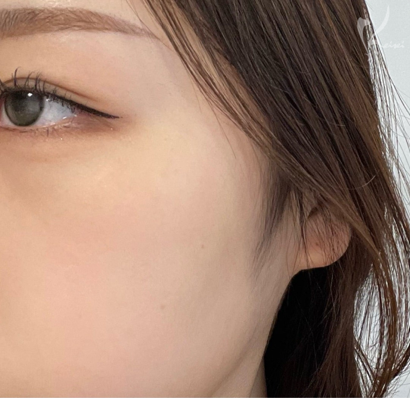 ダウンタイム後の写真