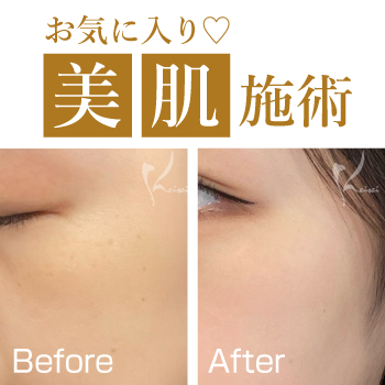 お気に入り美肌施術♡サムネイル