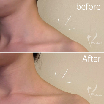 肩ボトックスで肩こり改善＆美肩へ！サムネイル