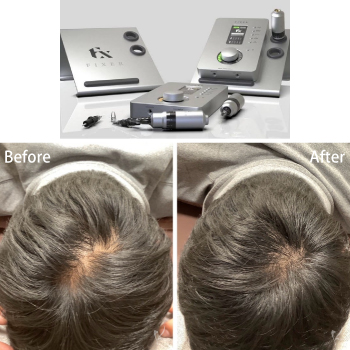 頭皮のアートメイクでお悩み解消！！サムネイル