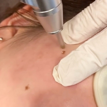 CO2レーザーでホクロをスマート除去 サムネイル