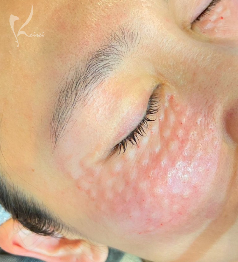 リズネ施術後写真