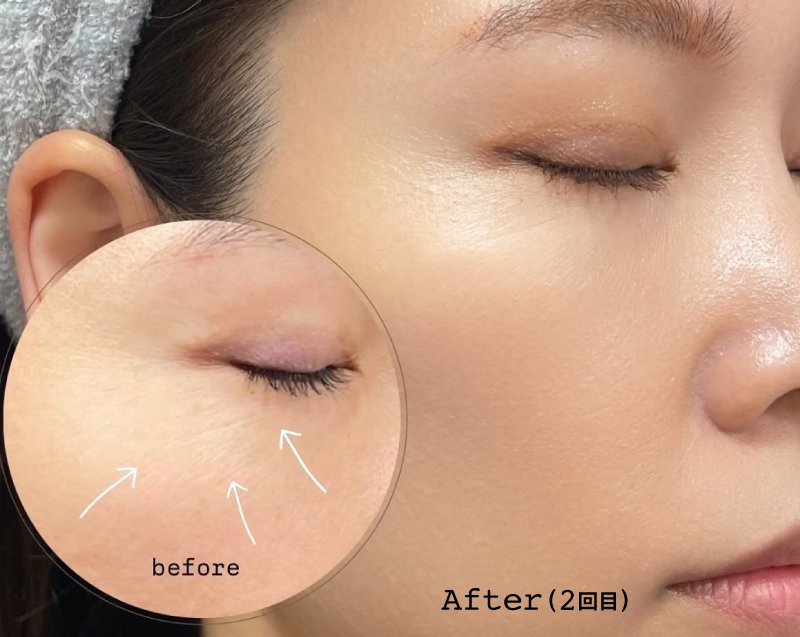 リズネAfter写真