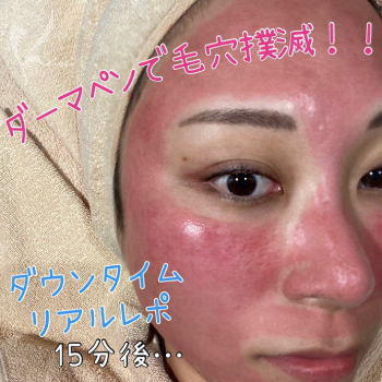 ダーマペン4で、毛穴撃退計画！！のサムネイル