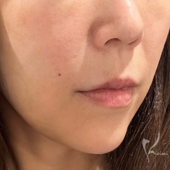 フォトフェイシャルによる赤み治療のサムネイル