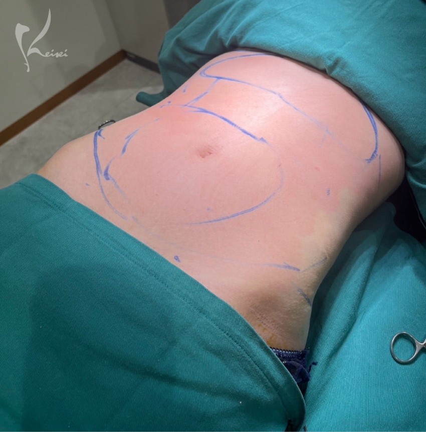 お腹の脂肪吸引　術後1ヶ月と3ヶ月の様子