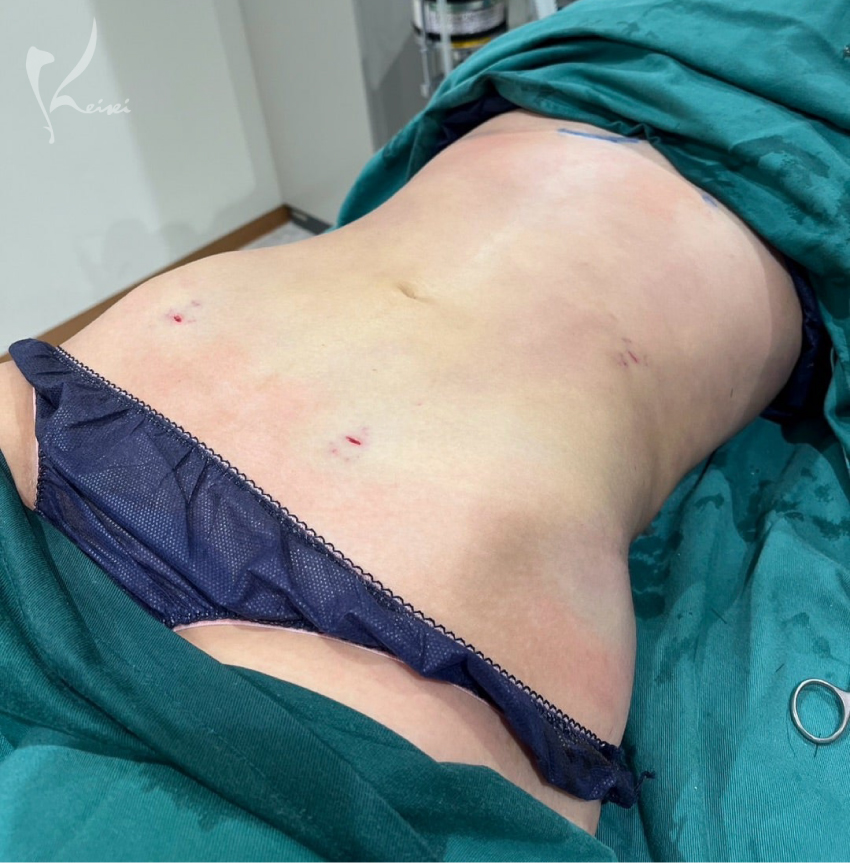 お腹の脂肪吸引　術後1ヶ月と3ヶ月の様子