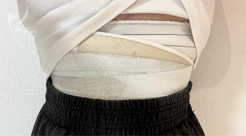 お腹の脂肪吸引　術後1ヶ月と3ヶ月の様子