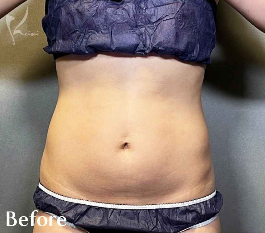 お腹の脂肪吸引　術後1ヶ月と3ヶ月の様子