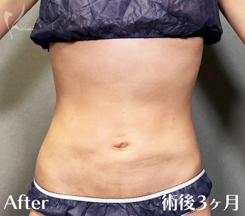 お腹の脂肪吸引　術後1ヶ月と3ヶ月の様子