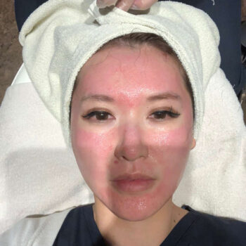 ワンランク上の若返り治療「幹細胞上清液(エクソソーム)」