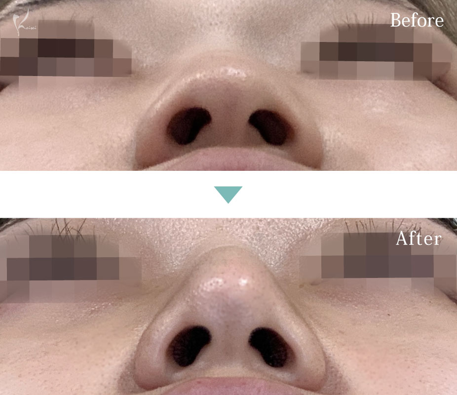 鼻のプロテーゼと鼻尖形成、ハンプ切除（鼻骨骨削り）の施術を行った下からの症例写真