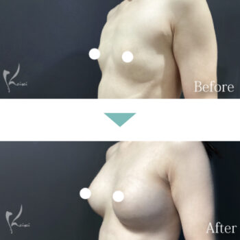 私の得意な施術 豊胸術（シリコンバッグ）