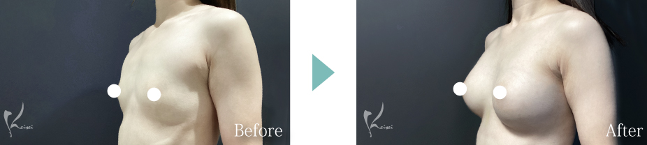 私の得意な施術 豊胸術（シリコンバッグ）